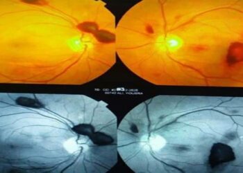 تدخل نوعي بالليزر يعيد البصر لمريضة بمشفى دمشق