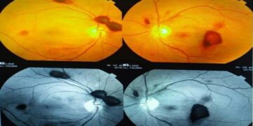 تدخل نوعي بالليزر يعيد البصر لمريضة بمشفى دمشق