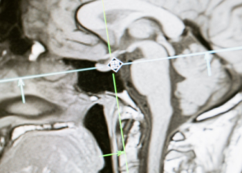 عادة شائعة قد تؤدي إلى تقليص دماغك وتراجع في الذاكرة!