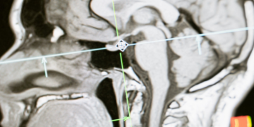 عادة شائعة قد تؤدي إلى تقليص دماغك وتراجع في الذاكرة!