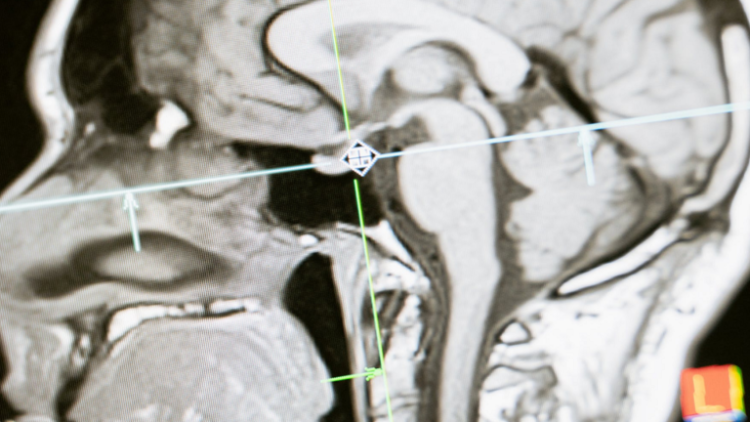 عادة شائعة قد تؤدي إلى تقليص دماغك وتراجع في الذاكرة!