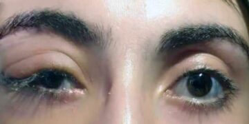 لأول مرة بمشفى المجتهد استئصال ورم وعائي عيني