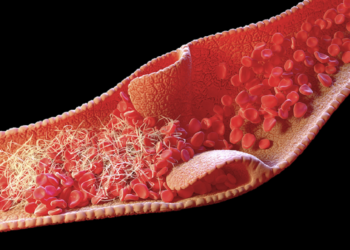 ماسبب تشكّل جلطات الدم لدى المصابين بـ”كوفيد-19″ الشديد؟