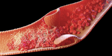 ماسبب تشكّل جلطات الدم لدى المصابين بـ”كوفيد-19″ الشديد؟