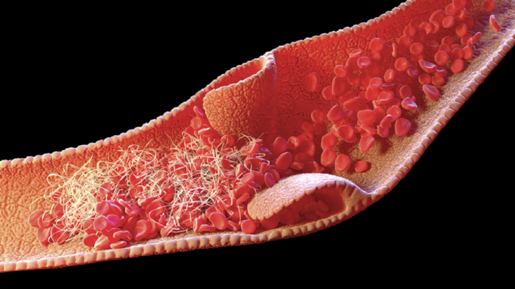 ماسبب تشكّل جلطات الدم لدى المصابين بـ”كوفيد-19″ الشديد؟